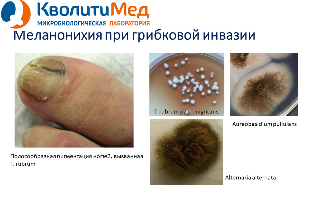 Меланонихия как признак онихомикоза